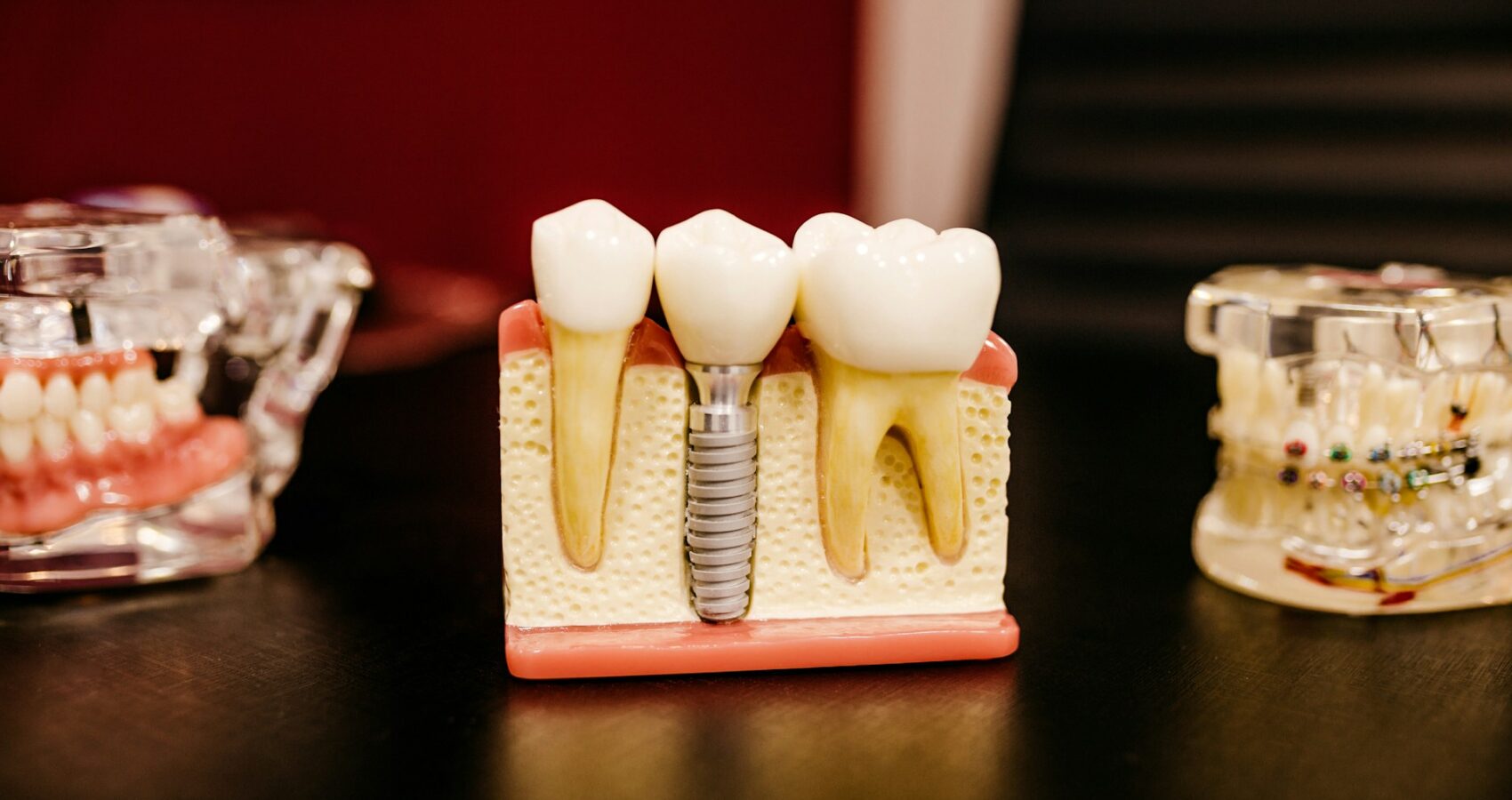Implanty zębowe – nowoczesne rozwiązanie dla pięknego uśmiechu